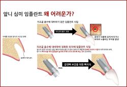 앞니 임플란트, 식립 위치·잇몸뼈 상태 함께 살펴야