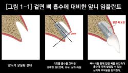 앞니 임플란트 재수술, 잇몸·잇몸뼈 상태 따라 판단
