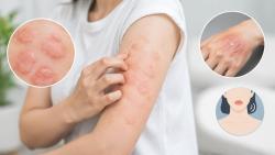 두드러기와 접촉피부염, 발진 시점·지속 양상 달라
